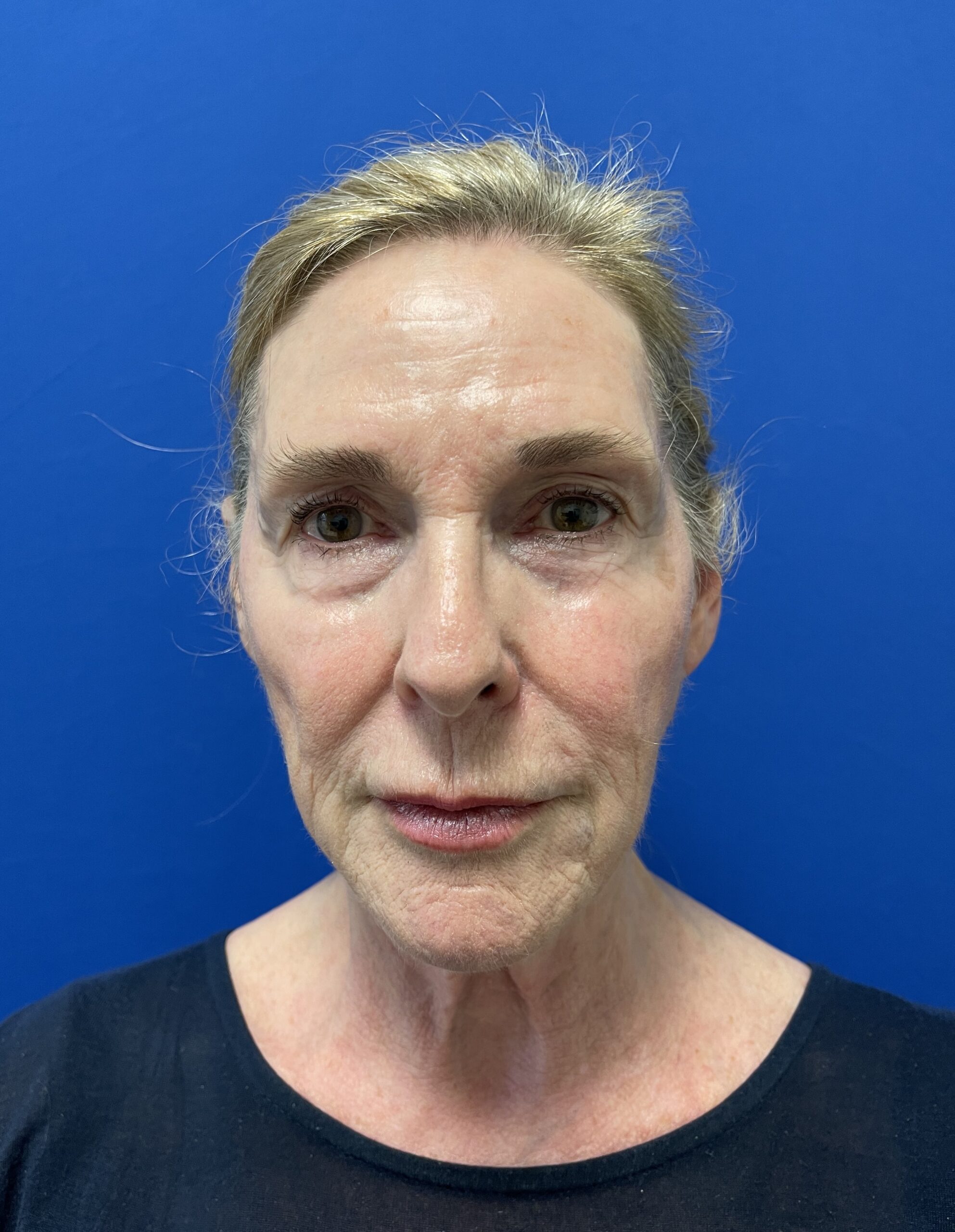 Facelift-Case--1339 | Before Facelift