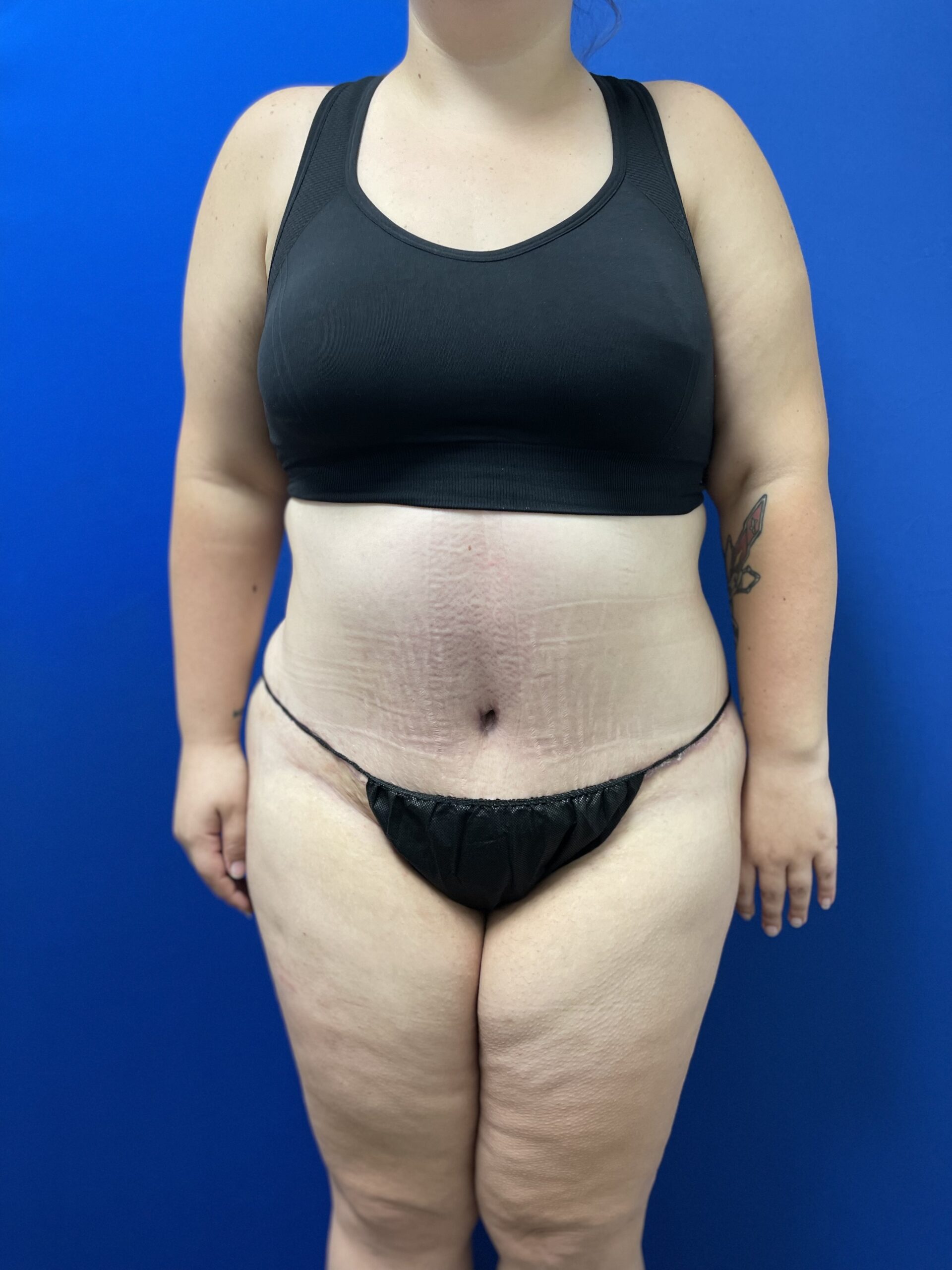 Before---038--After-Cali-Tuck--x2122----Abdominoplasty----New-Orleans--Lousiana | After Cali-Tuck™ (Tummy Tuck)