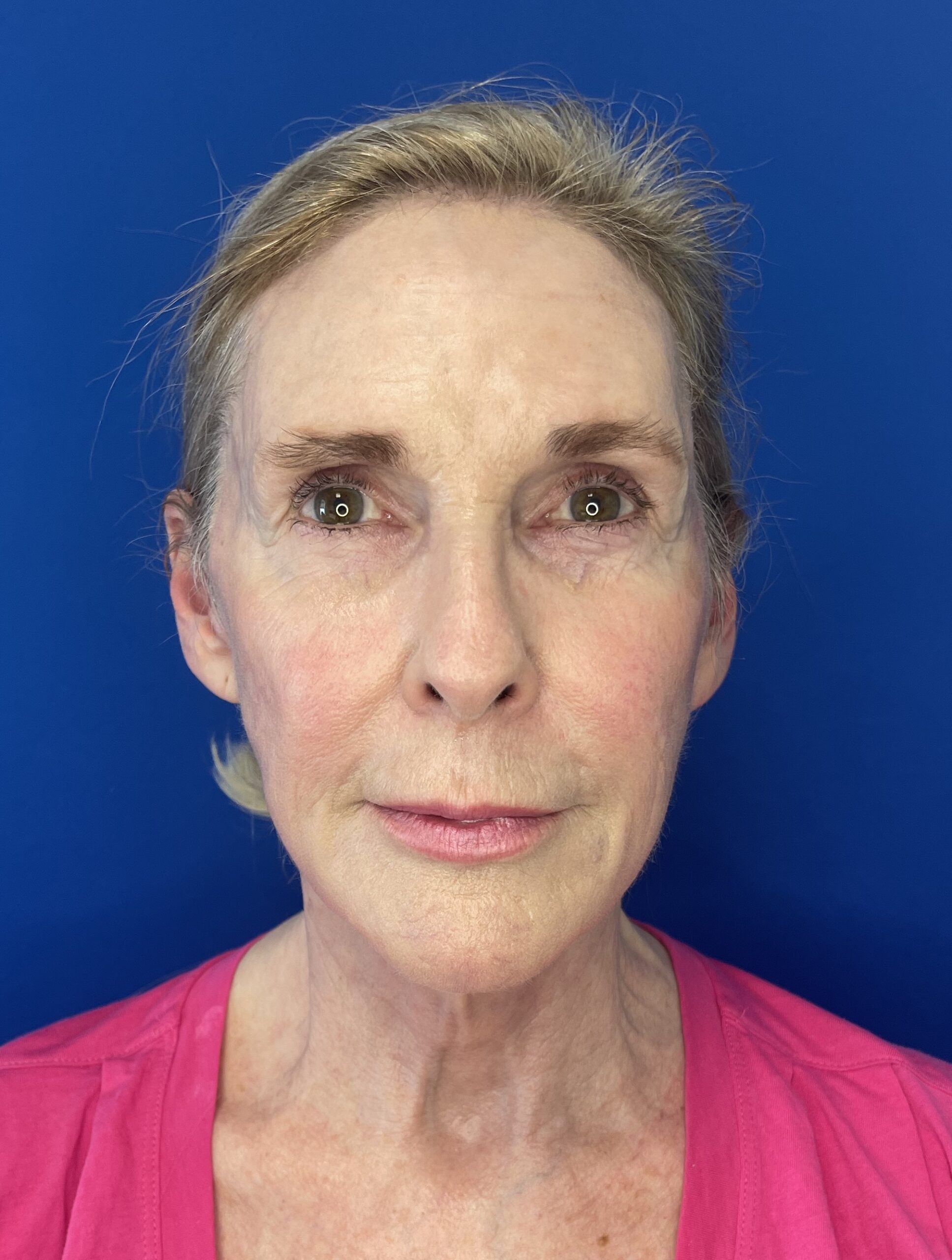 Facelift-Case--1339 | After Facelift