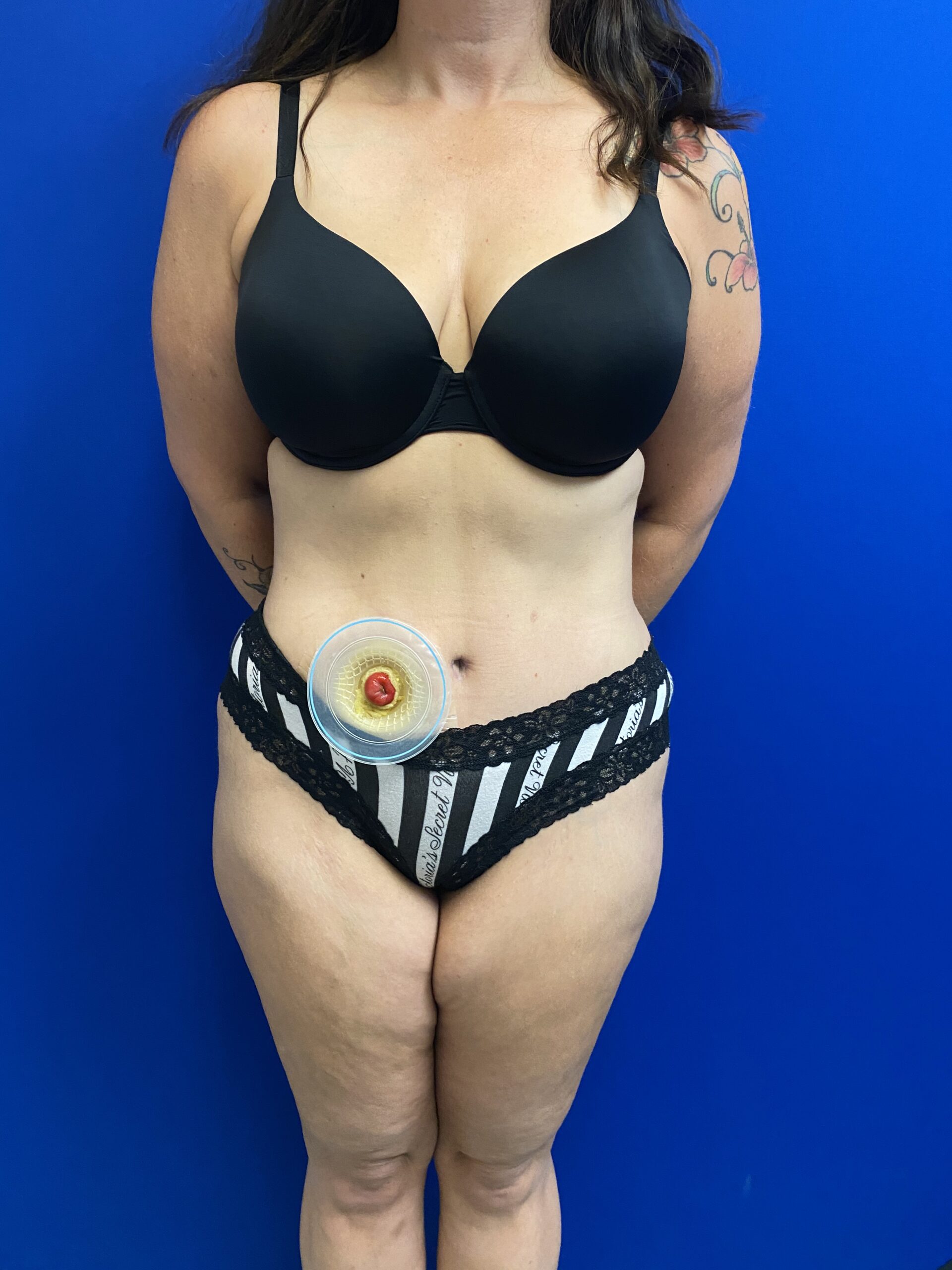 Cali-Tuck--x2122---Tummy-Tuck--Case--7951 | After Cali-Tuck™ (Tummy Tuck)