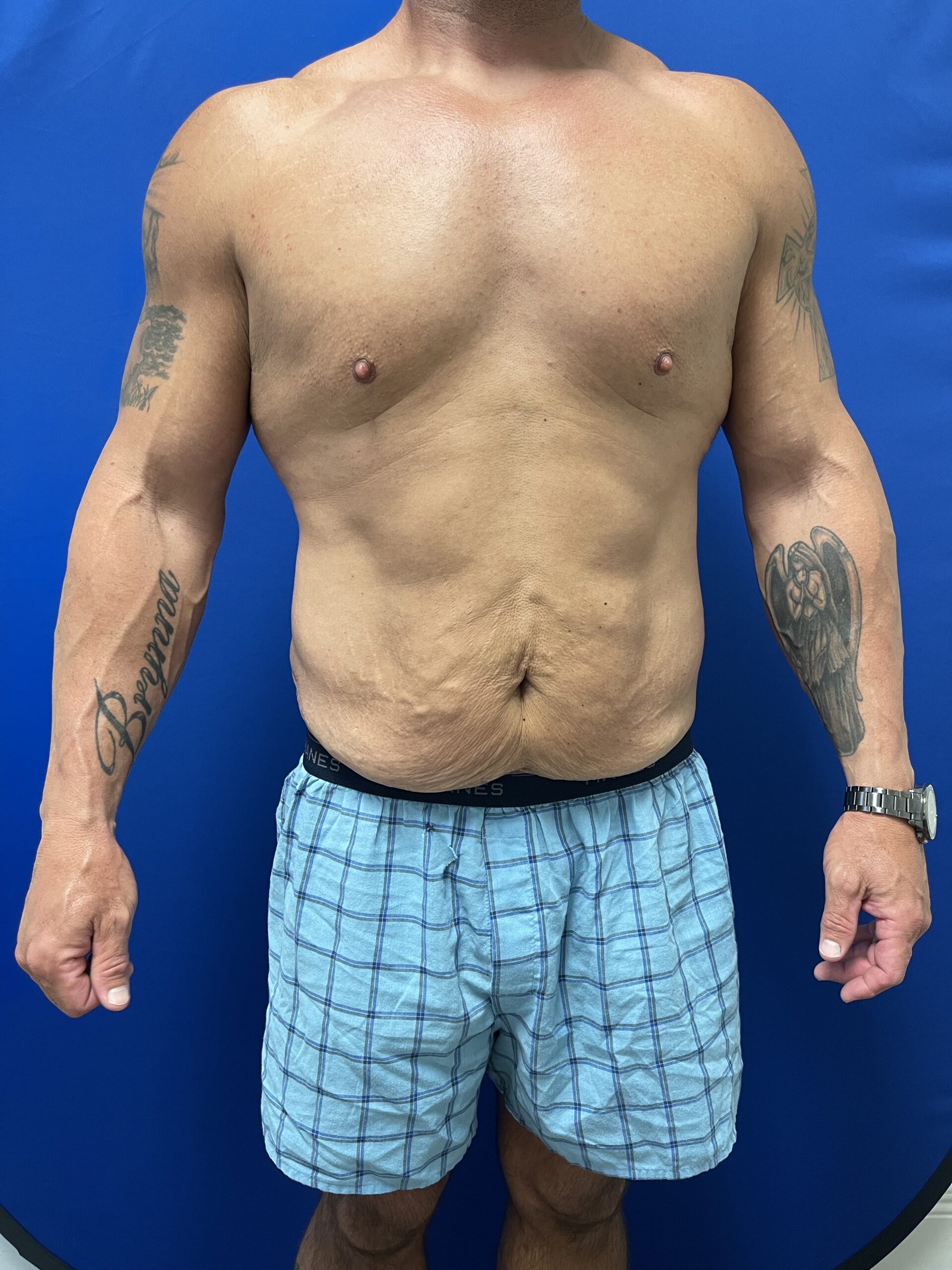 Case--2683 | Before Male Procedures