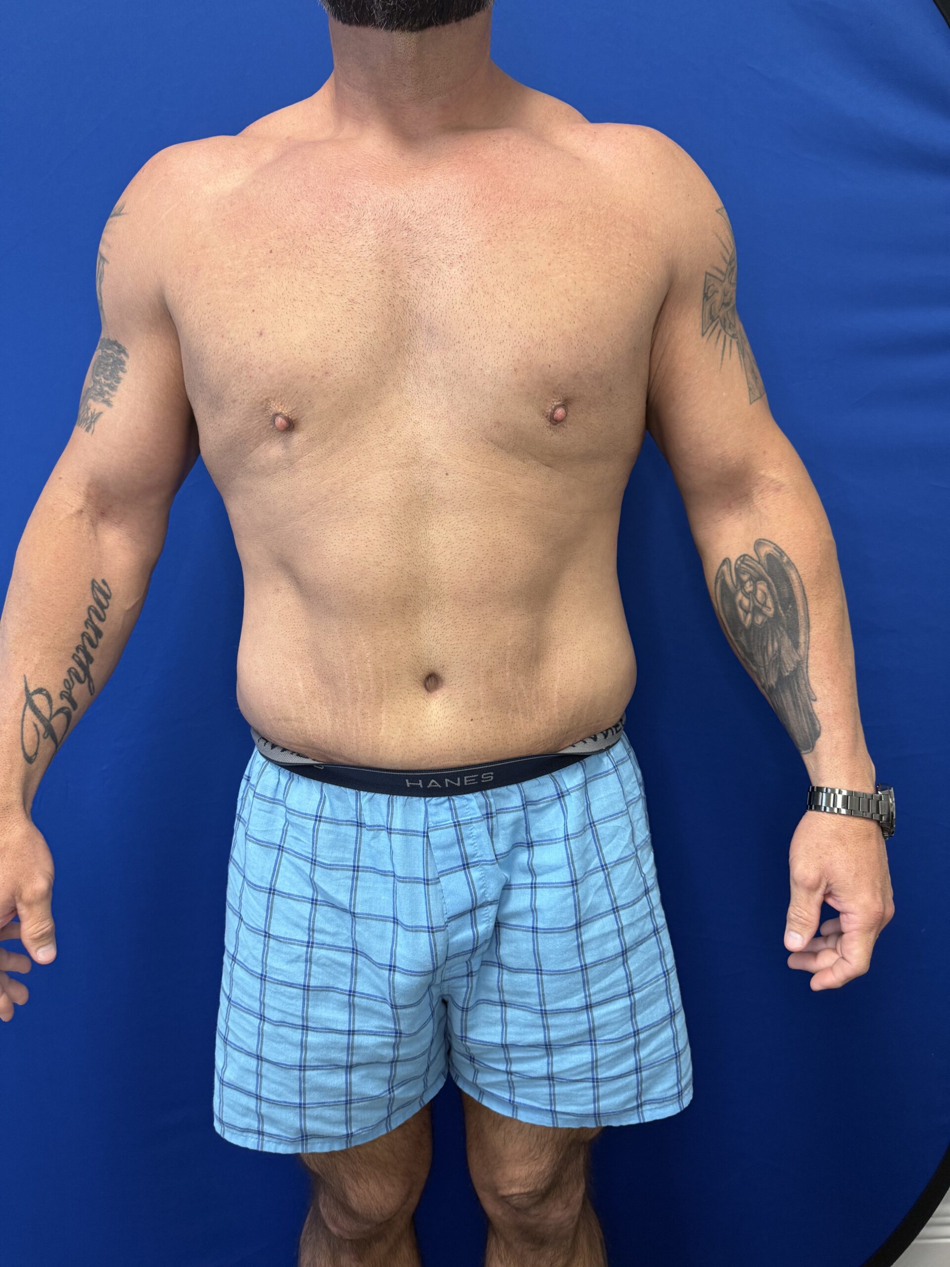 Case--2683 | After Male Procedures