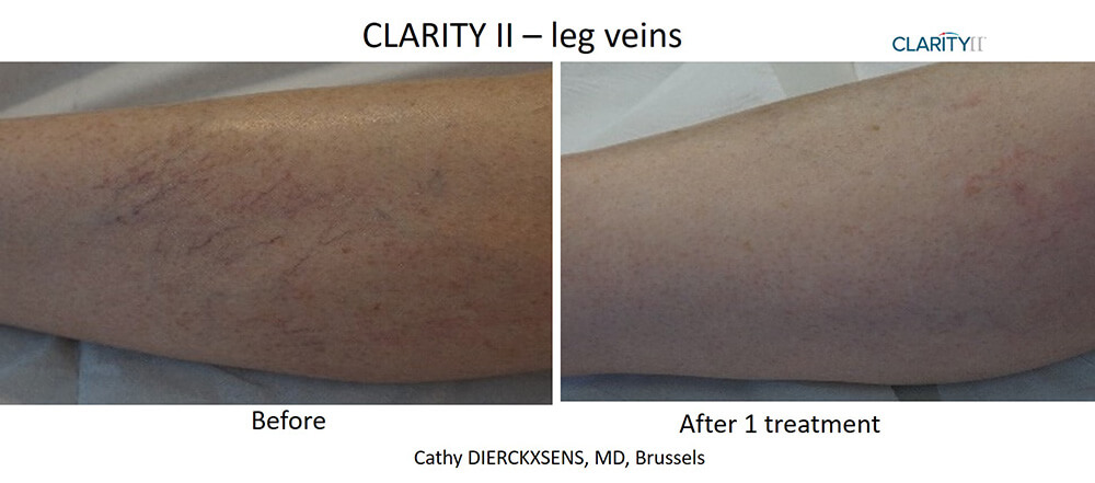 B&A Clarity II Dierckxsens Leg Veins