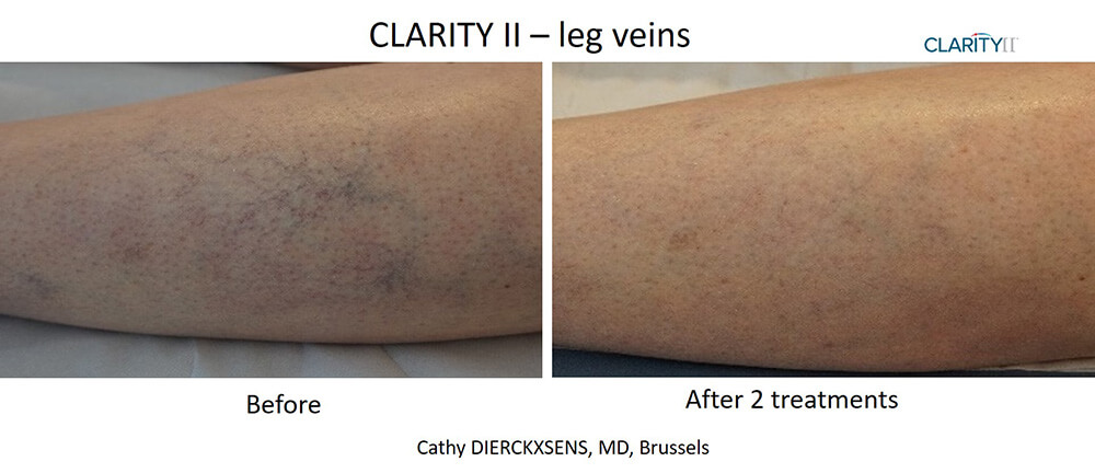 B&A Clarity II Dierckxsens Leg Veins
