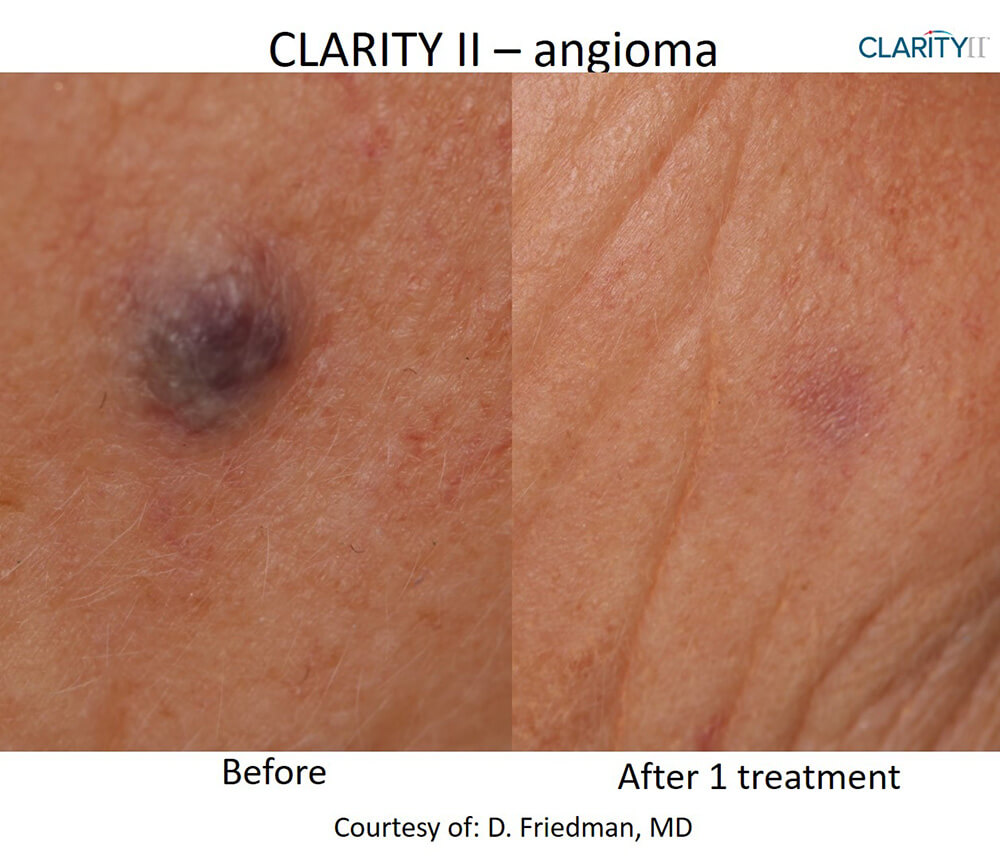 B&A Clarity II Friedman Angioma