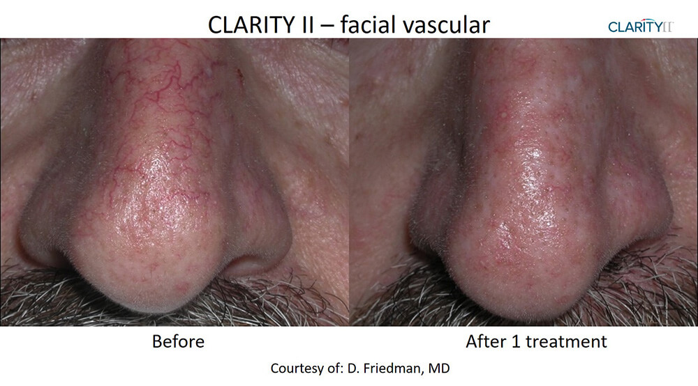 B&A Clarity II Friedman Nasal Veins (2)
