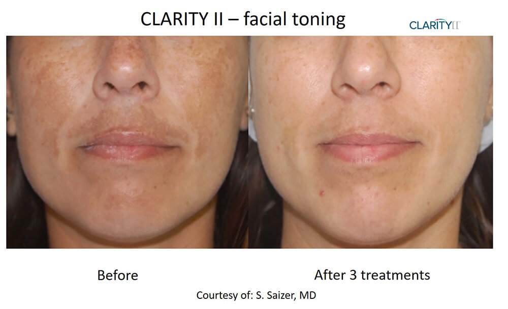 B&A Clarity II Saizer Facial Toning