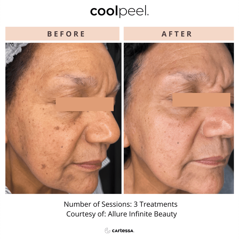 CoolPeel6