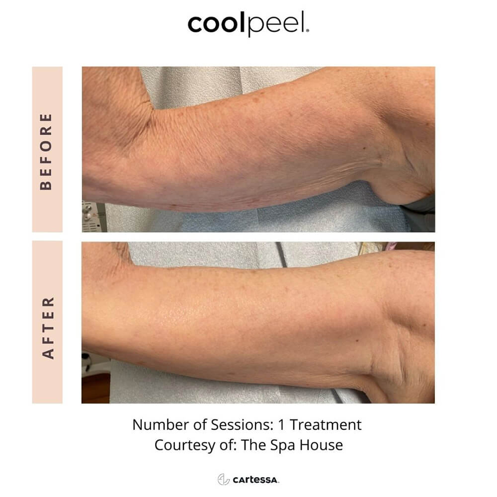 CoolPeelArms