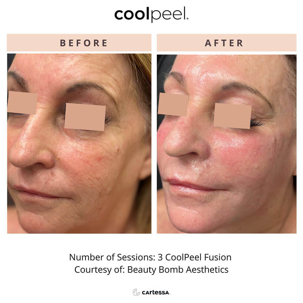 CoolPeelFusionBeauty