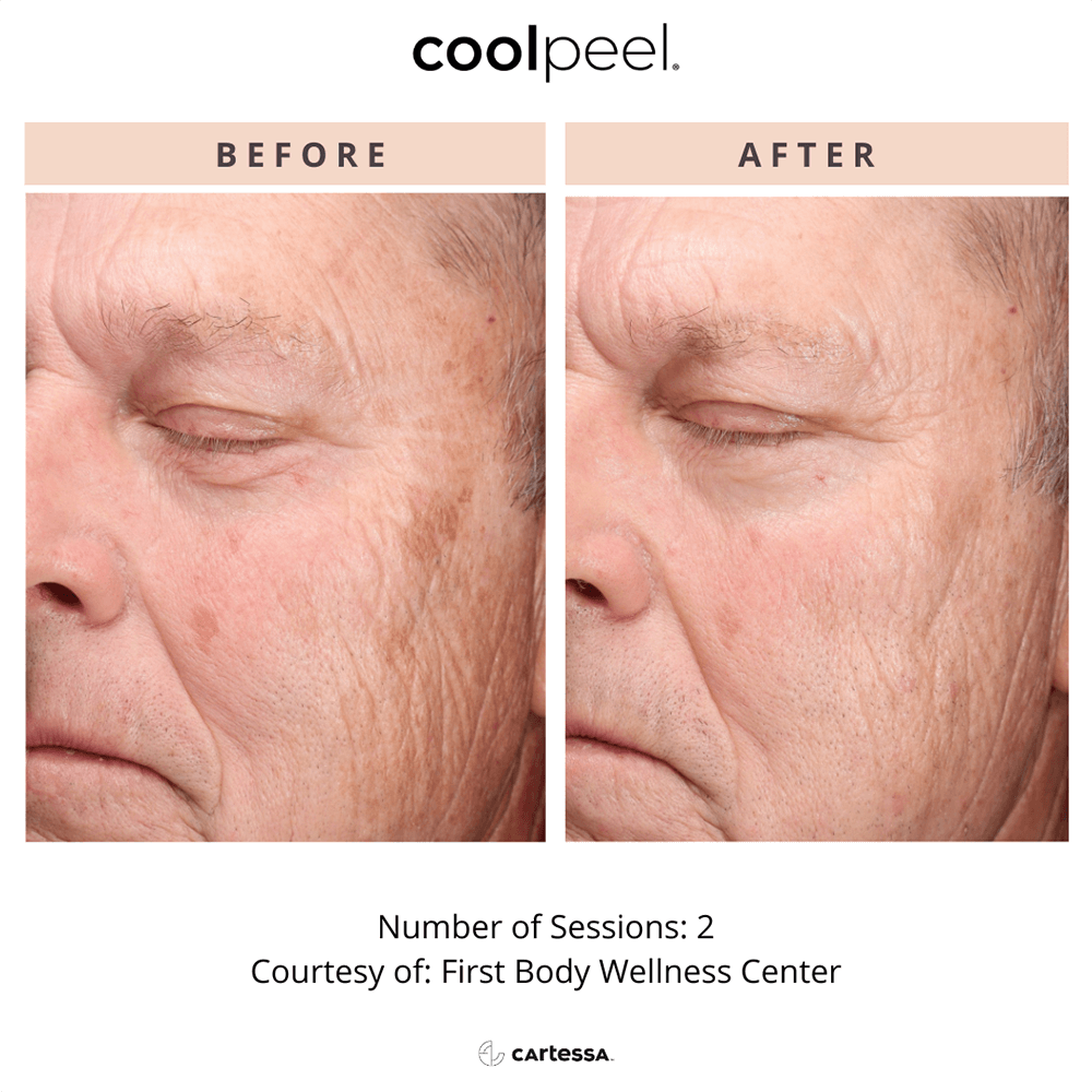 CoolPeelTemplate5