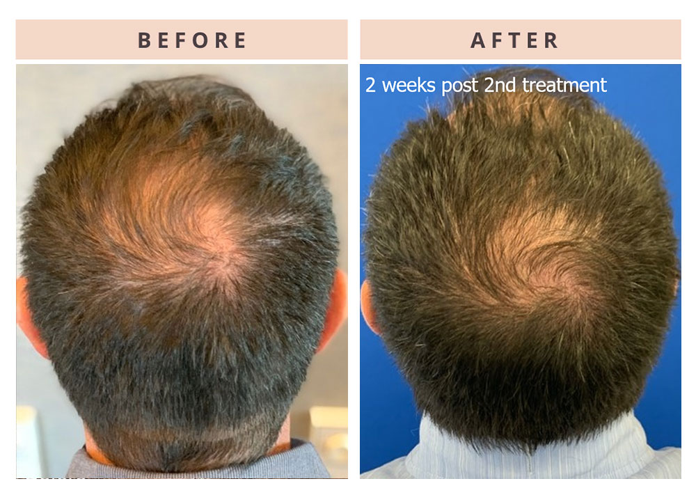 hair-restoration-patient-1