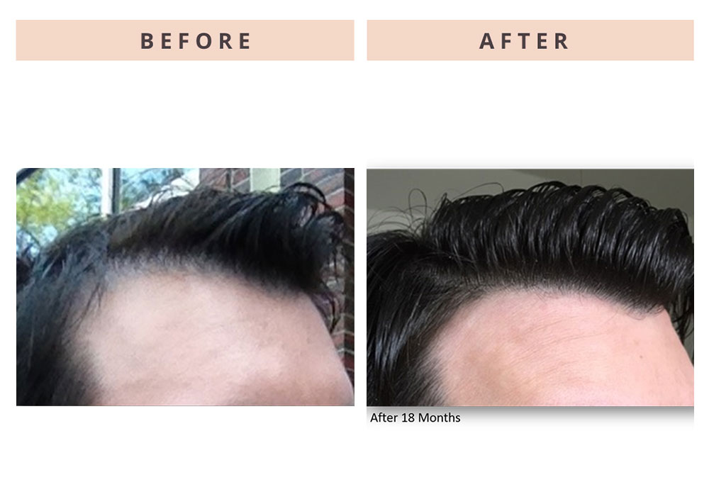 hair-restoration-patient-2