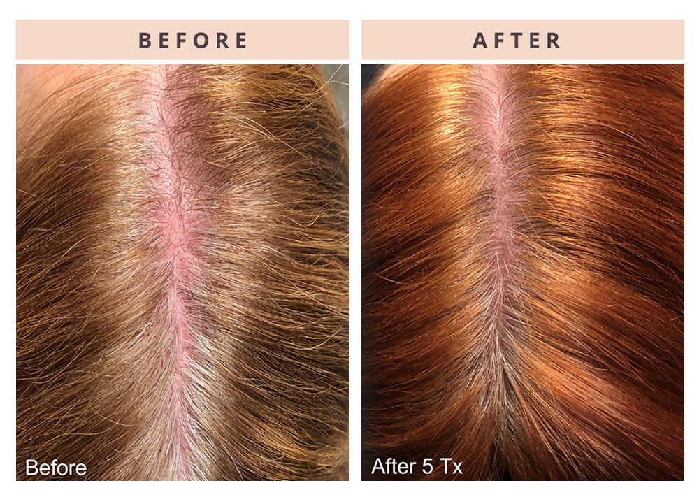 hair-restoration-patient-3