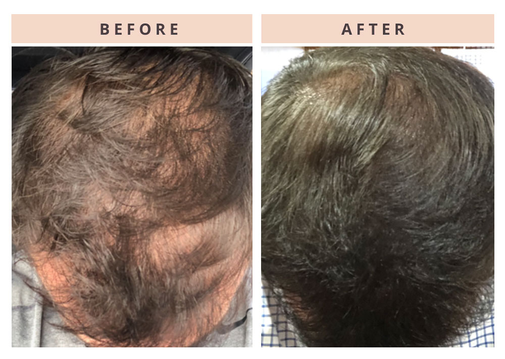 hair-restoration-patient-4