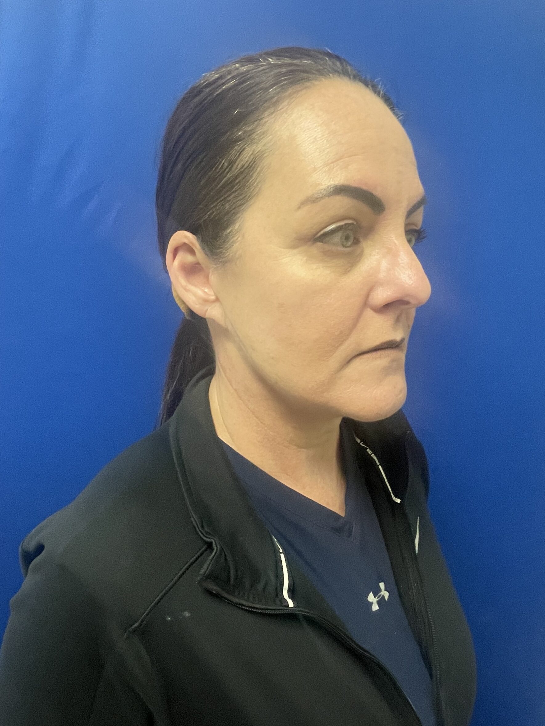 Facelift-Case--8205 | After Facelift