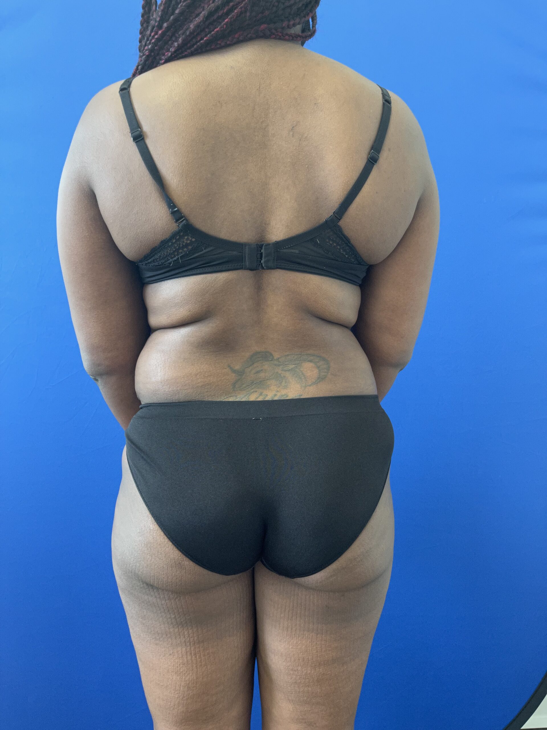 High-Definition-Liposuction-Case--1049 | Before High Definition Liposuction