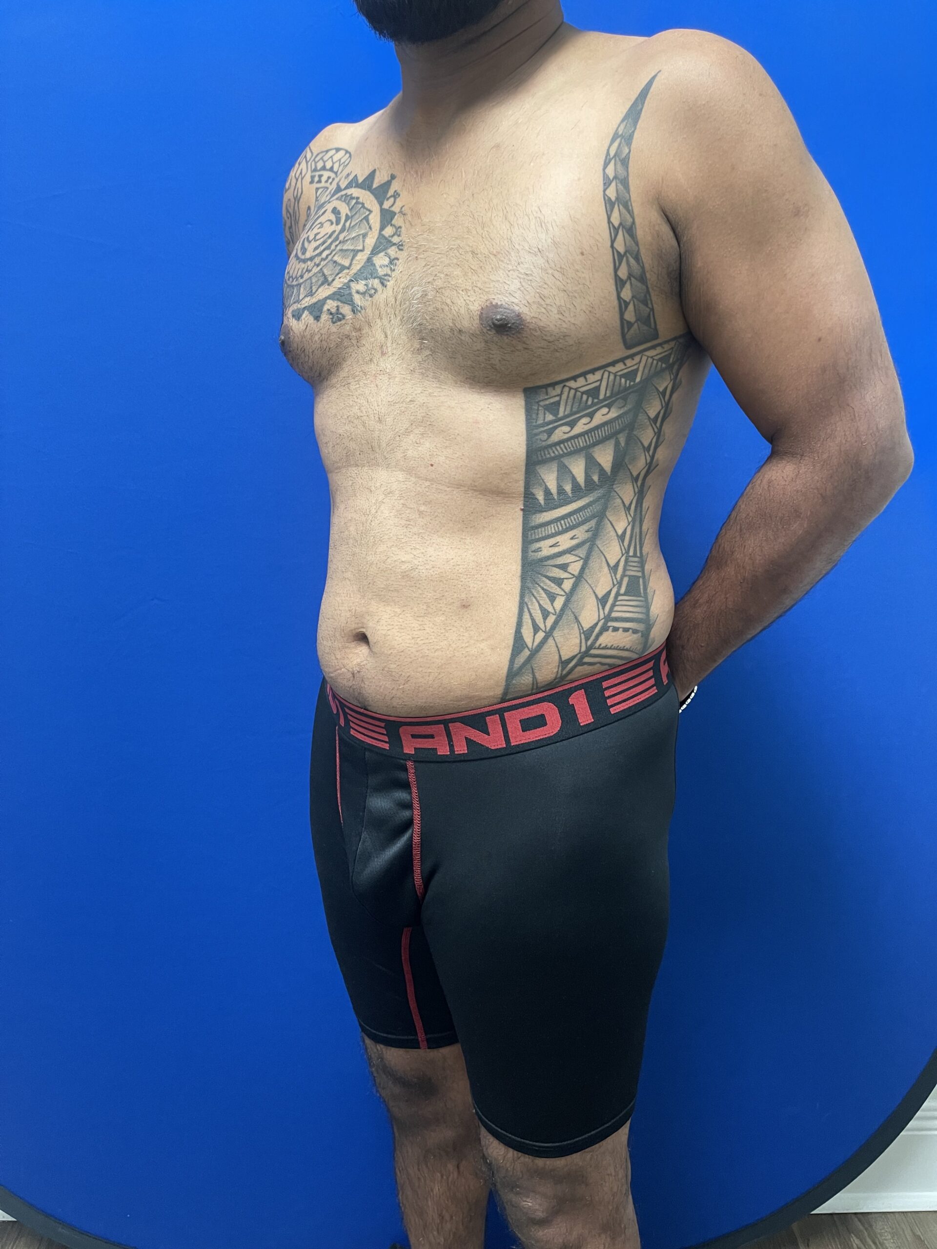 Abdominal-Pectoral-Etching-Case--2062 | Before Male Procedures