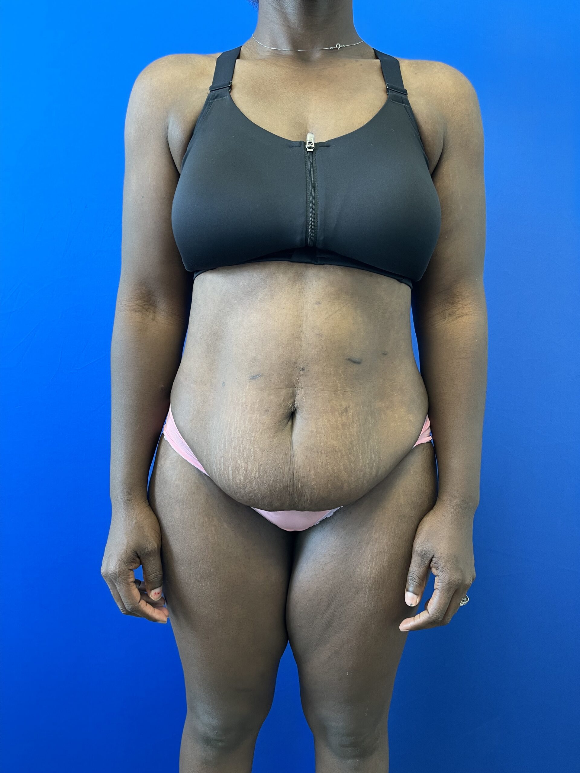 Before---038--After--Abdominoplasty | Before Cali-Tuck™ (Tummy Tuck)