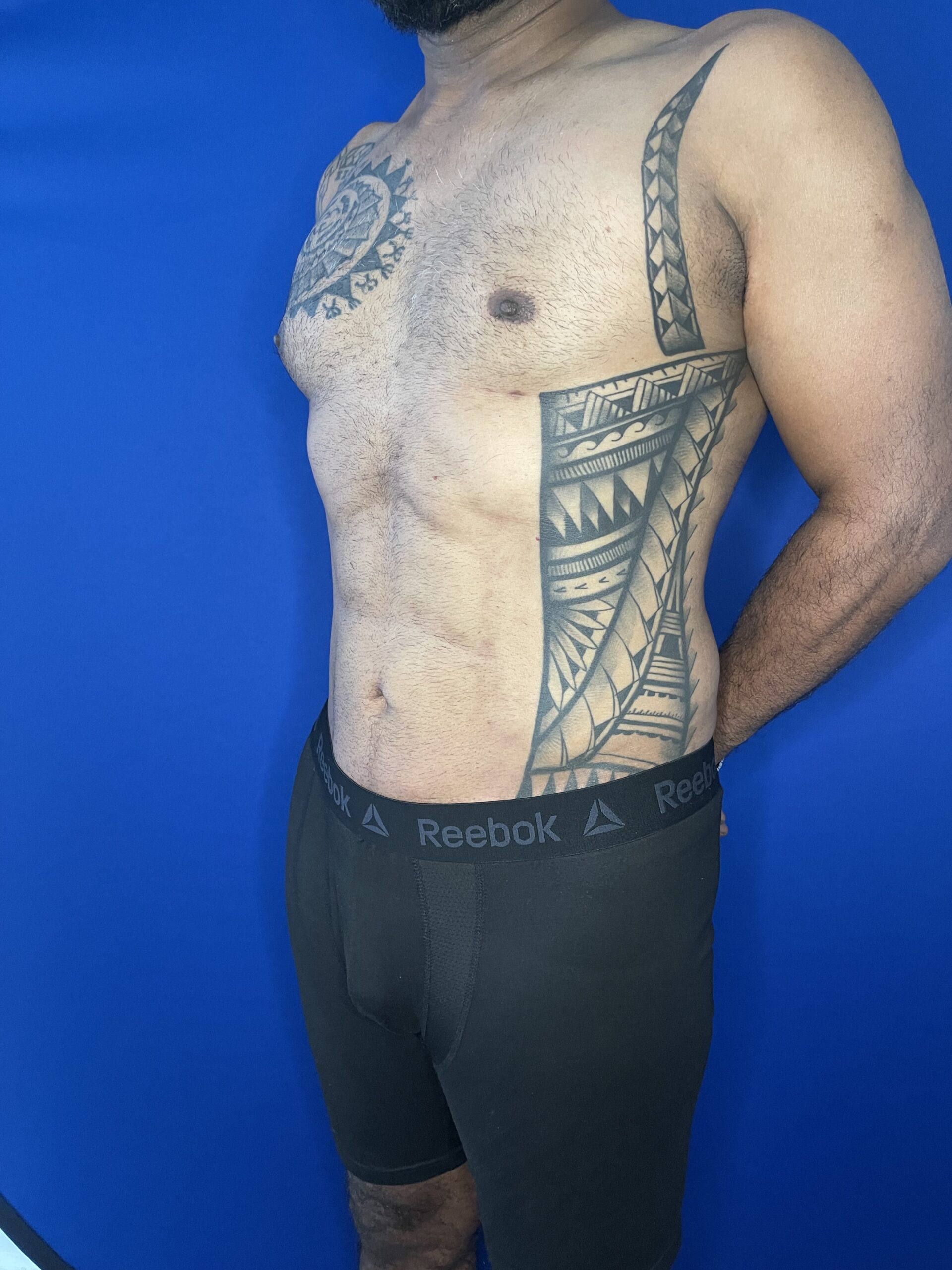 Abdominal-Pectoral-Etching-Case--2062 | After Male Procedures