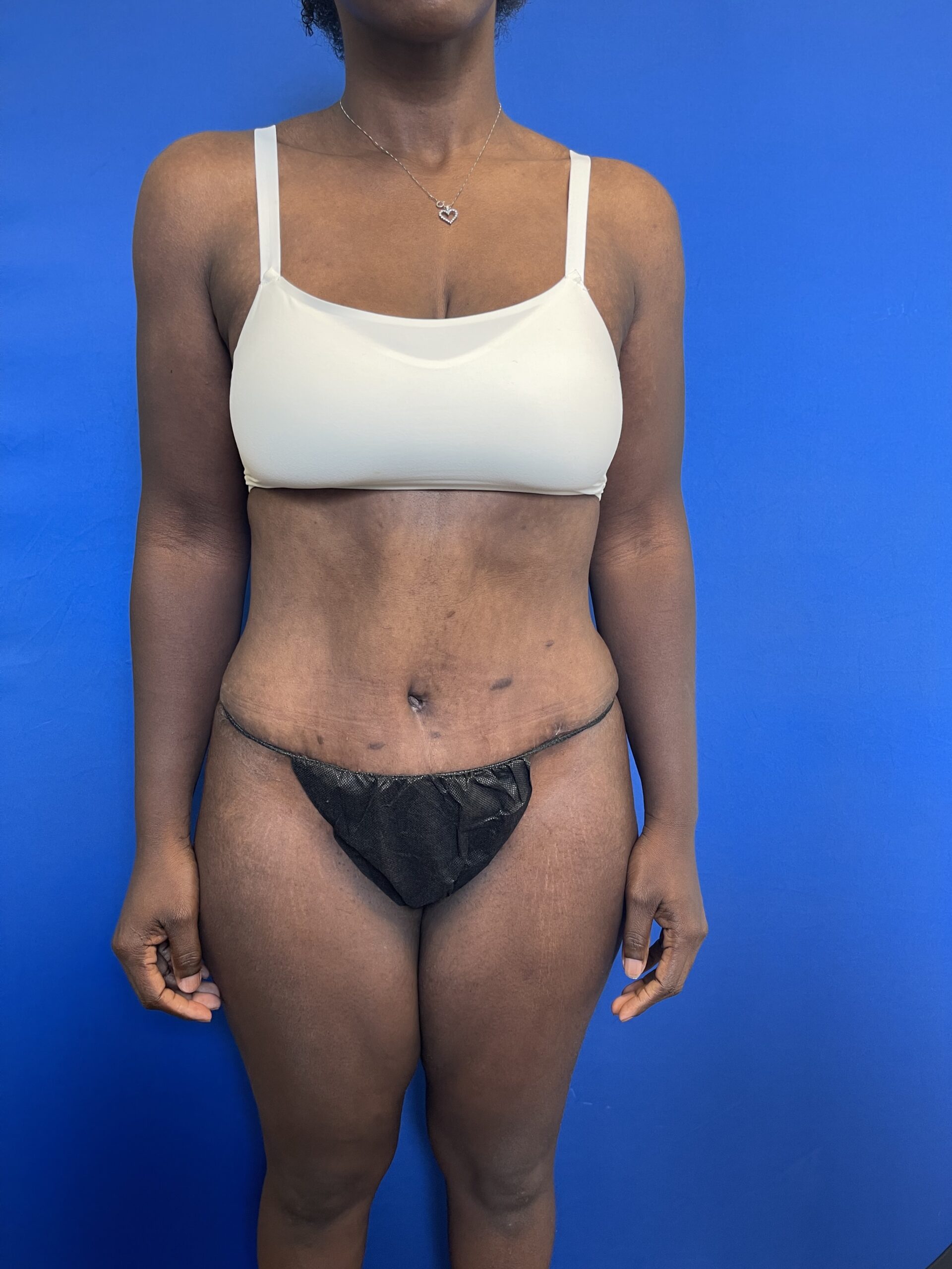 Before---038--After--Abdominoplasty | After Cali-Tuck™ (Tummy Tuck)