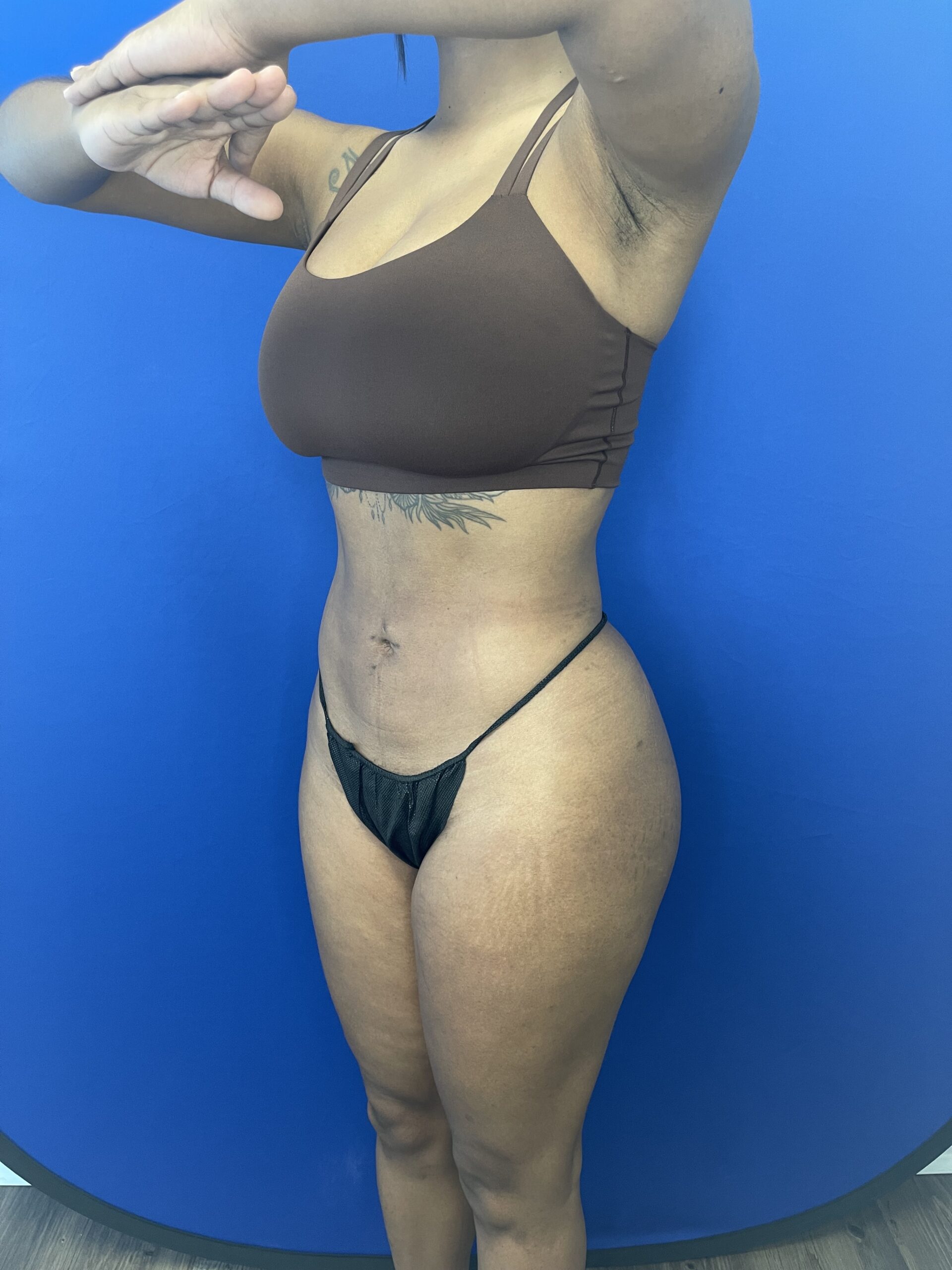 High-Definition-Liposuction-Case--7922 | After High Definition Liposuction