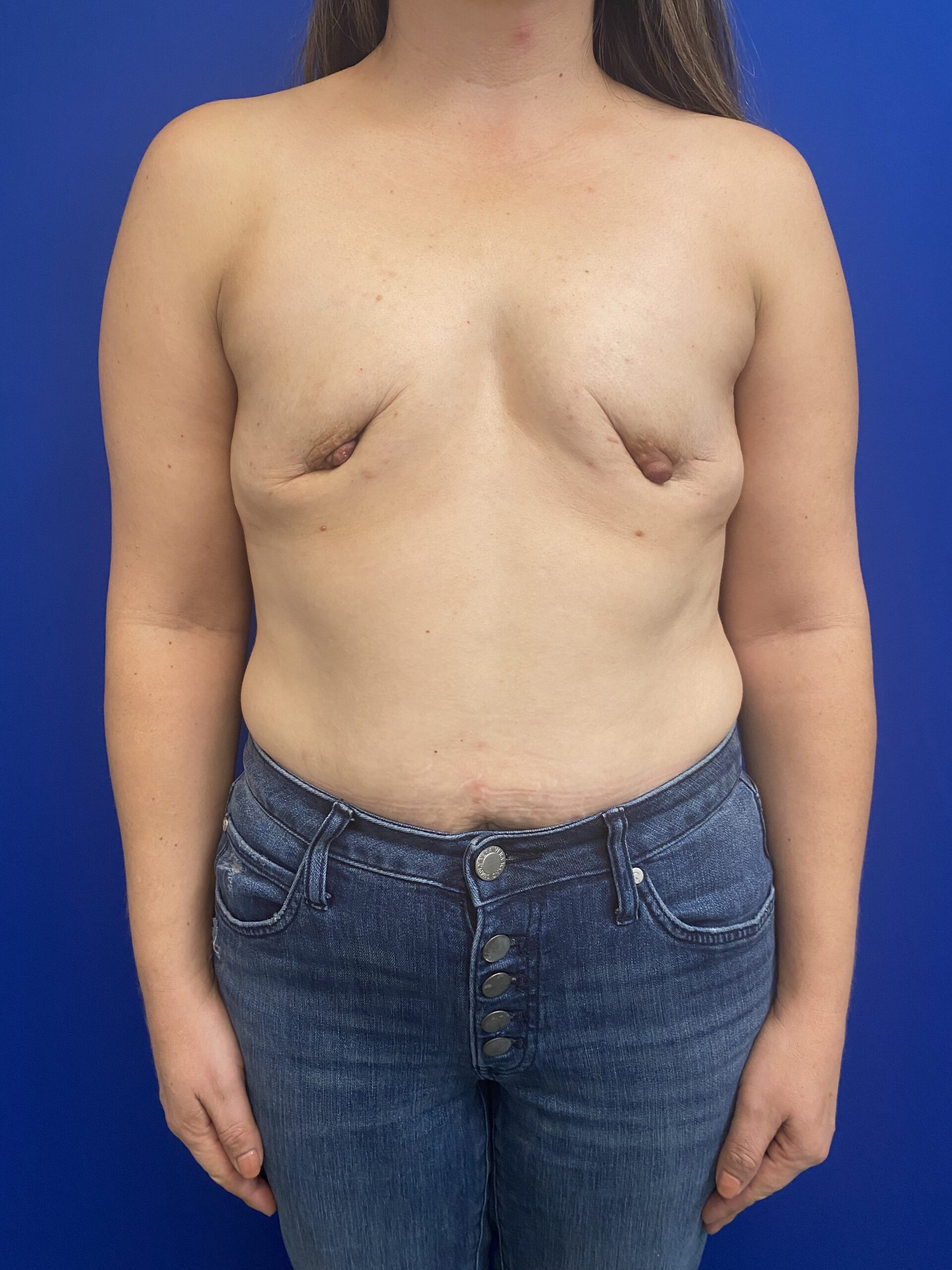 Breast-Reconstruction-Case--8386 | Before Breast Surgery