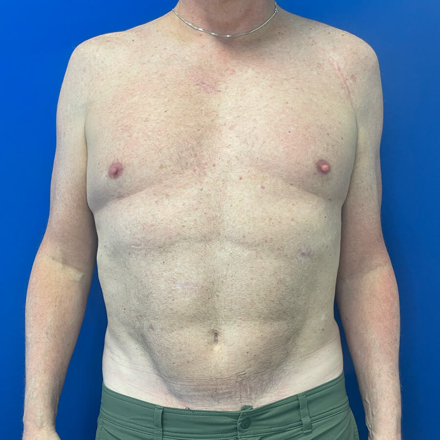 Abdominal-Pectoral-Etching-Case--5684 | After Male Procedures