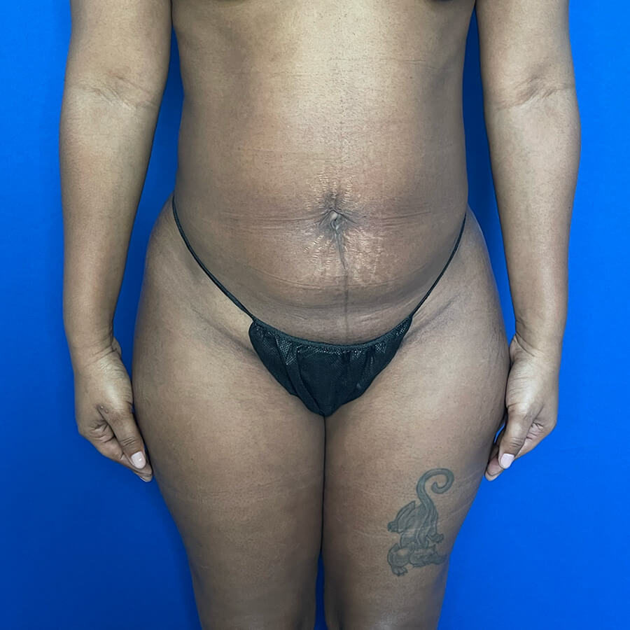 High-Definition-Liposuction-Case--3061 | After High Definition Liposuction