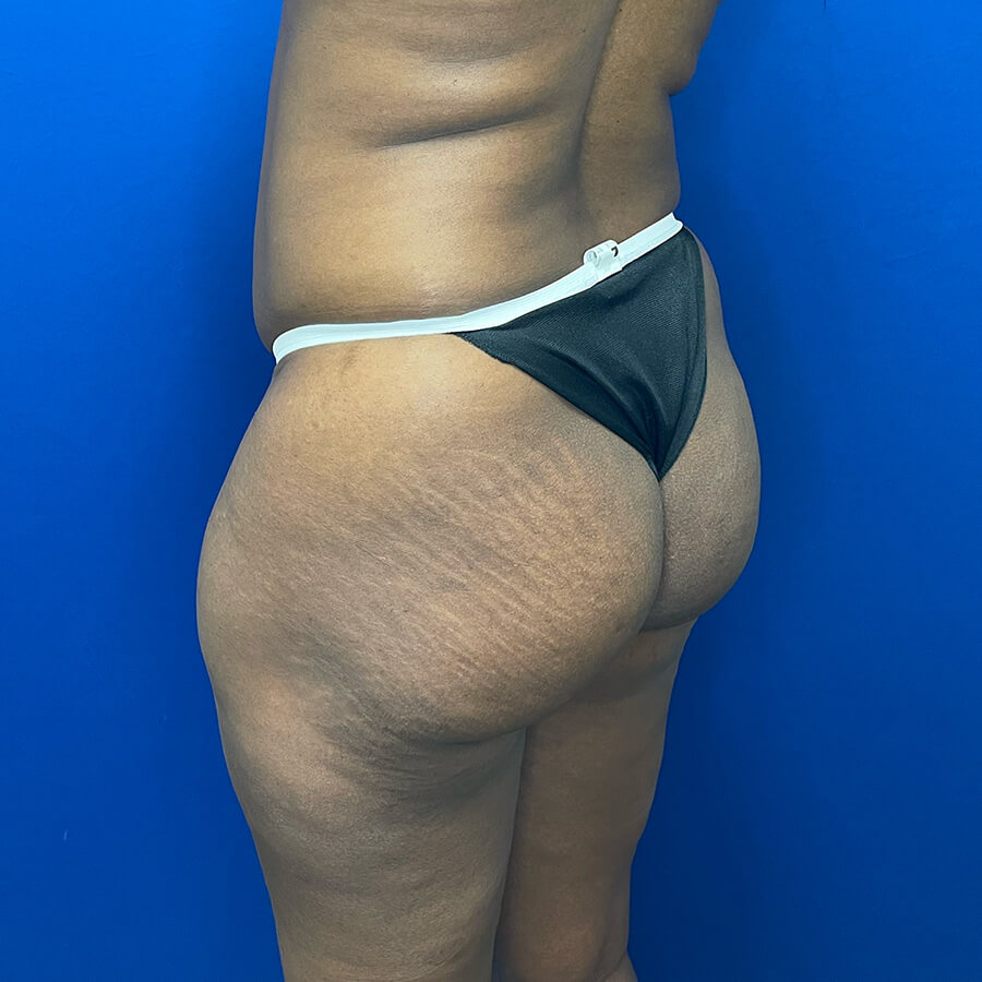 Brazilian-Butt-Lift-Case--9655 | Before Brazilian Butt Lift