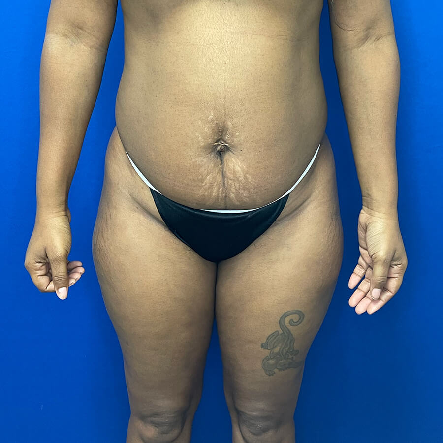 High-Definition-Liposuction-Case--3061 | Before High Definition Liposuction