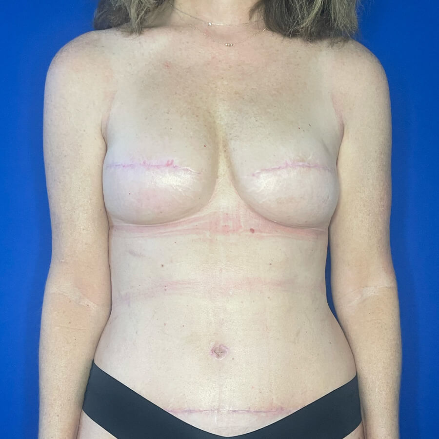 Breast-Reconstruction-Case--2235 | After Breast Surgery