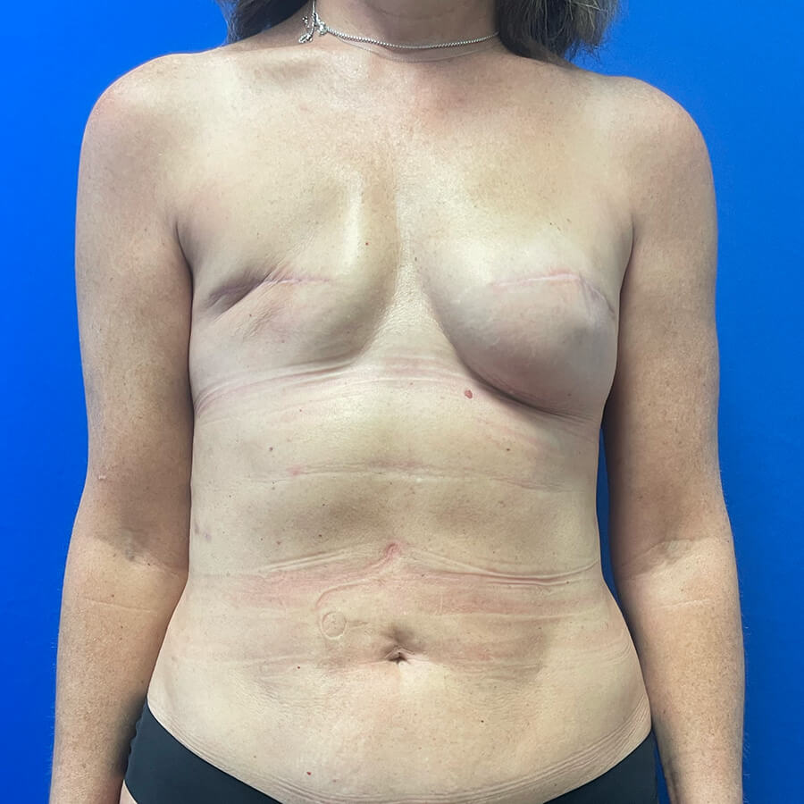 Breast-Reconstruction-Case--2235 | Before Breast Surgery