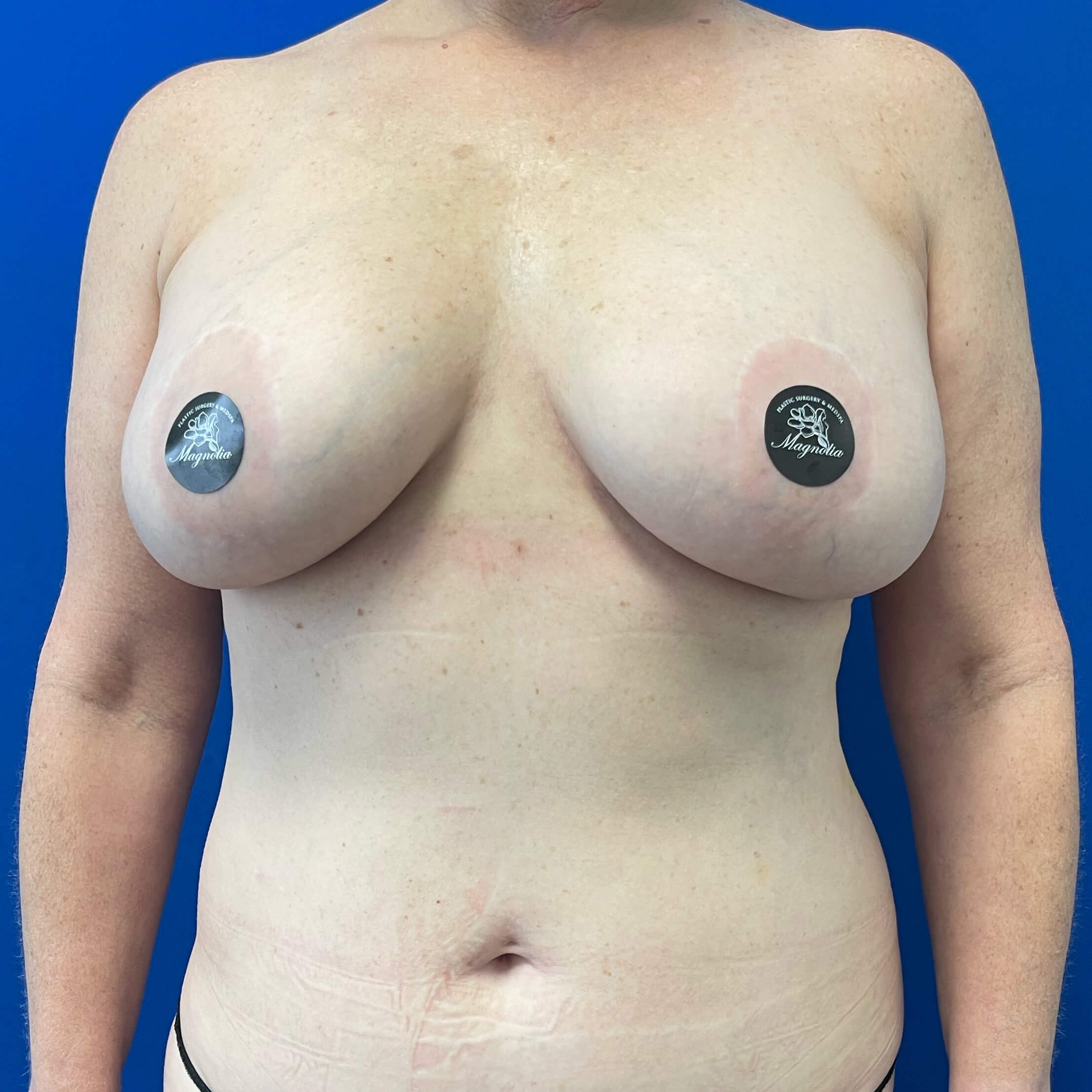 Cali-Tuck--x2122---Tummy-Tuck--Case--9145 | Before Cali-Tuck™ (Tummy Tuck)