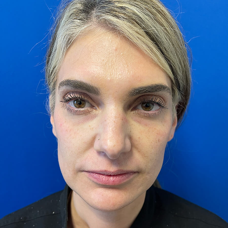 Dermal-Fillers-Case--2734 | Before Dermal Fillers