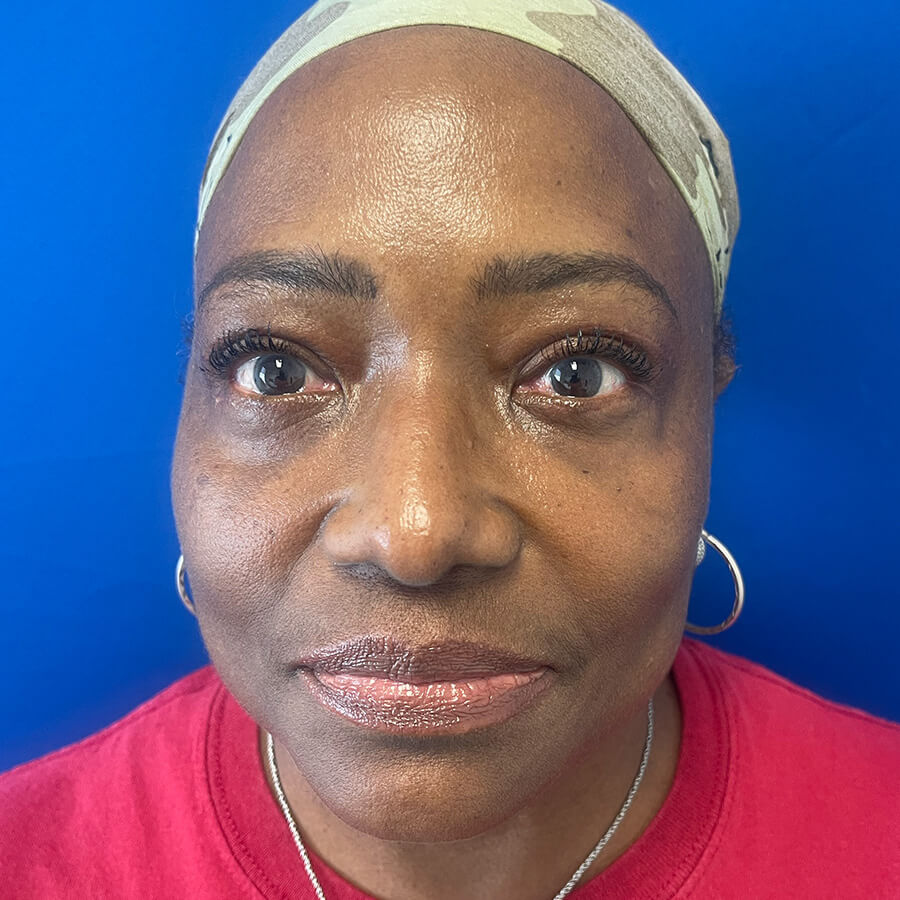 Eyelid-Surgery-Case--5785 | After Eyelid Surgery