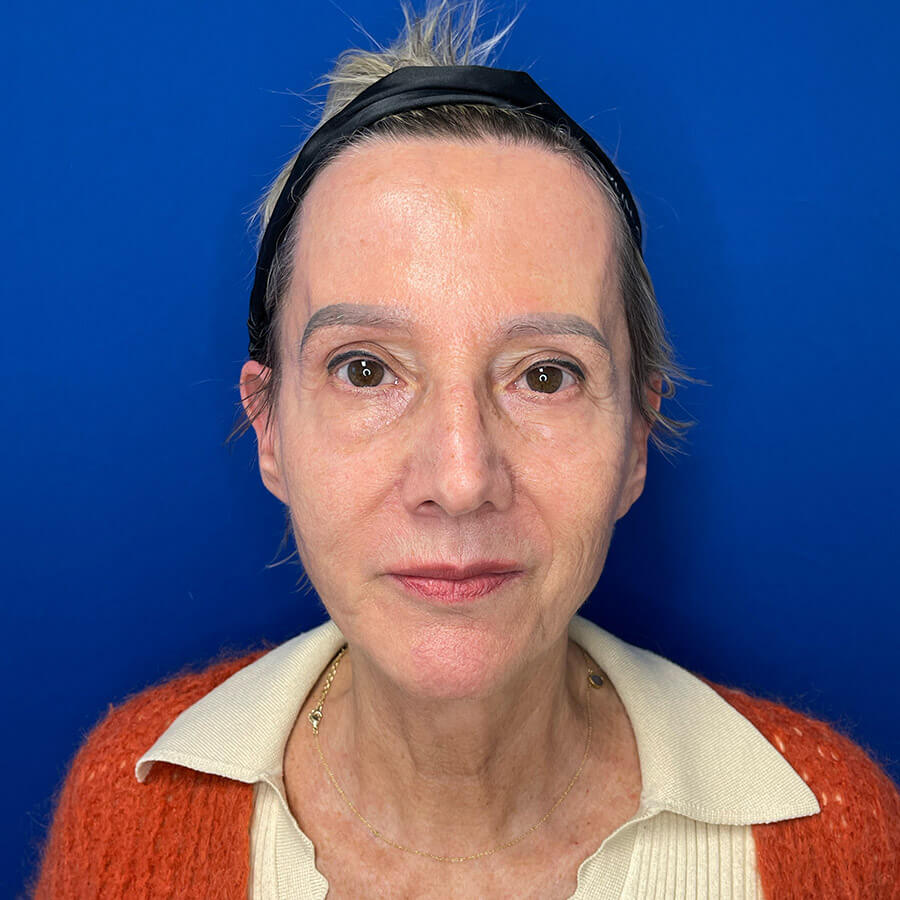 Facelift-Case--4230 | Before Facelift