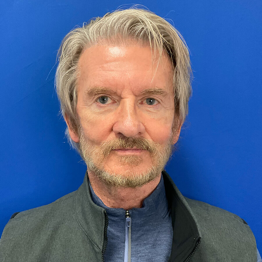 Facial-Fat-Grafting-Case--3302 | After Facial Fat Grafting