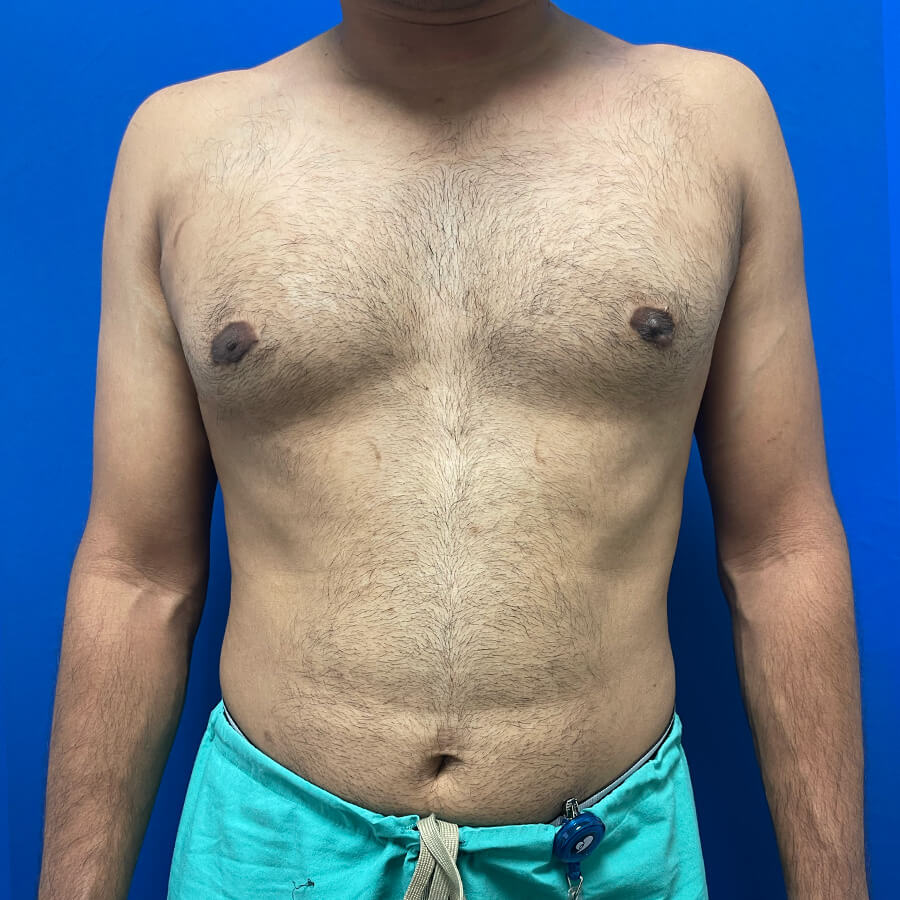 Gynecomastia-Case--9185 | After Male Procedures