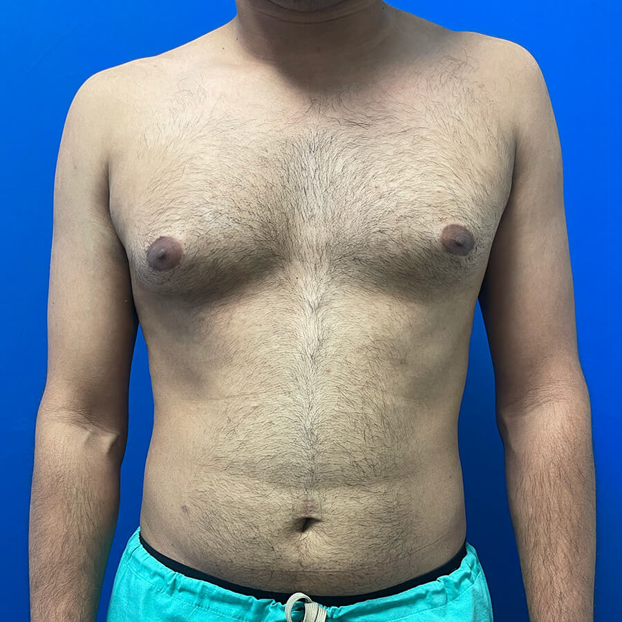 Gynecomastia-Case--9185 | Before Male Procedures