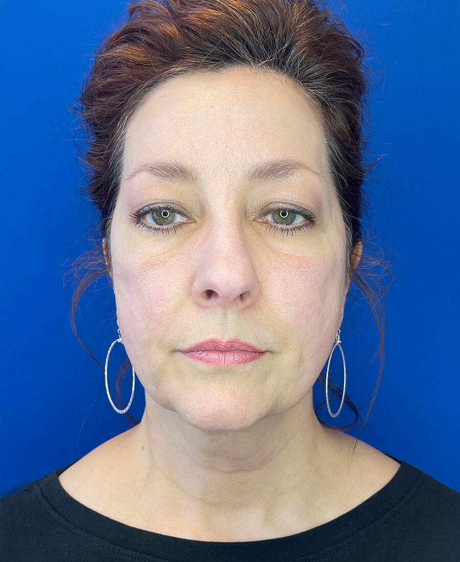 Laser-Treatments-Case--8151 | After Laser Treatments