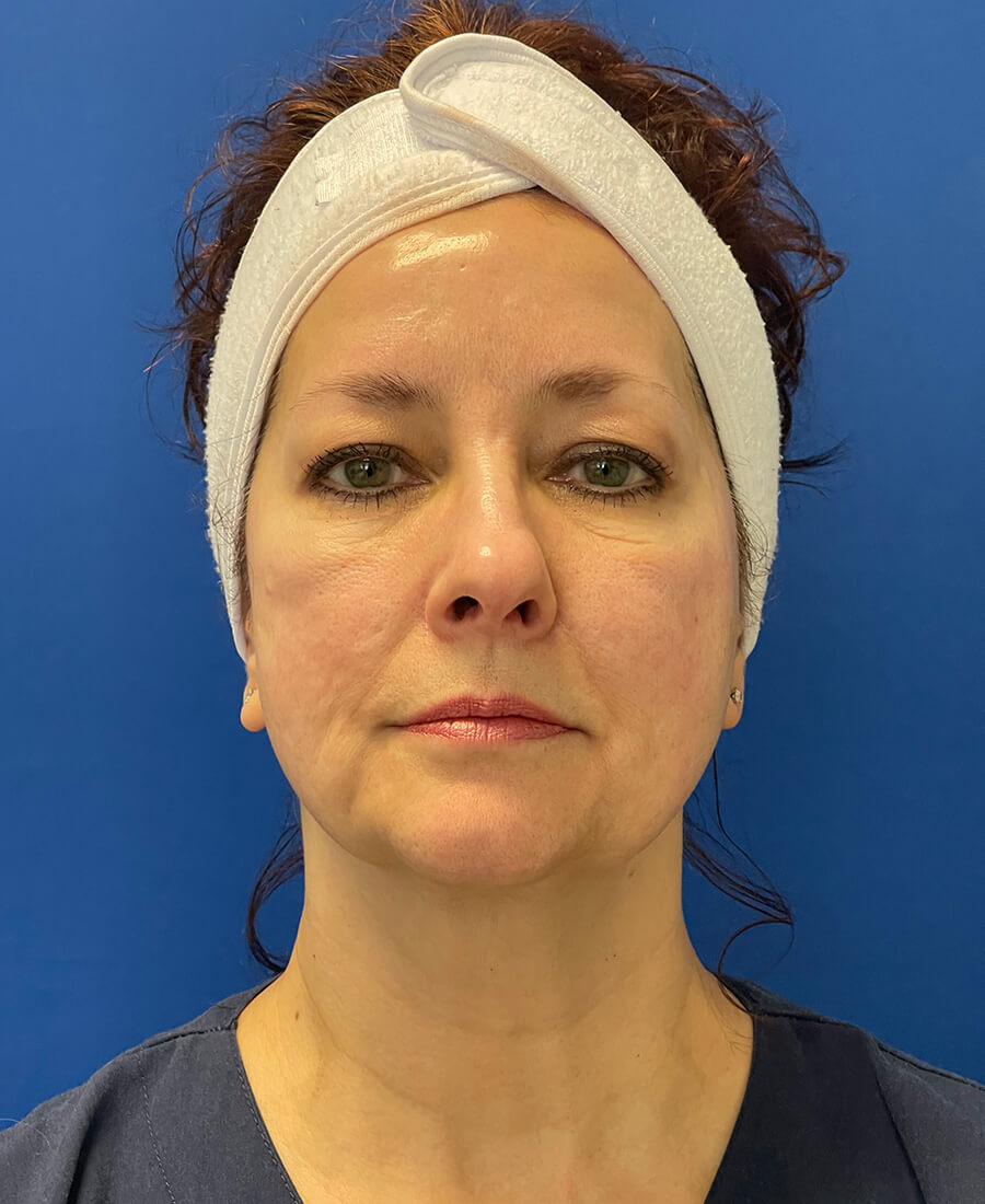 Laser-Treatments-Case--8151 | Before Laser Treatments