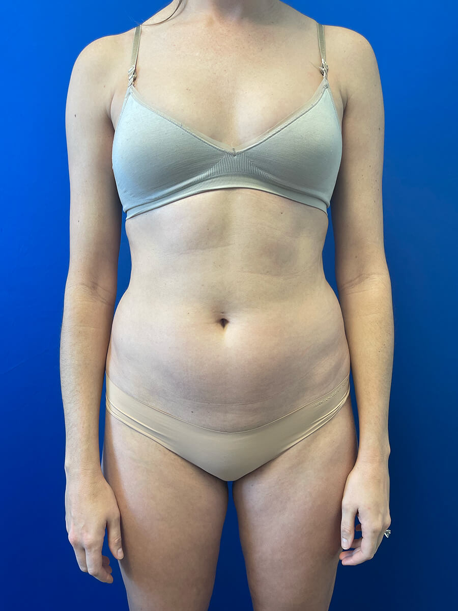 High-Definition-Liposuction-Case--2554 | Before High Definition Liposuction