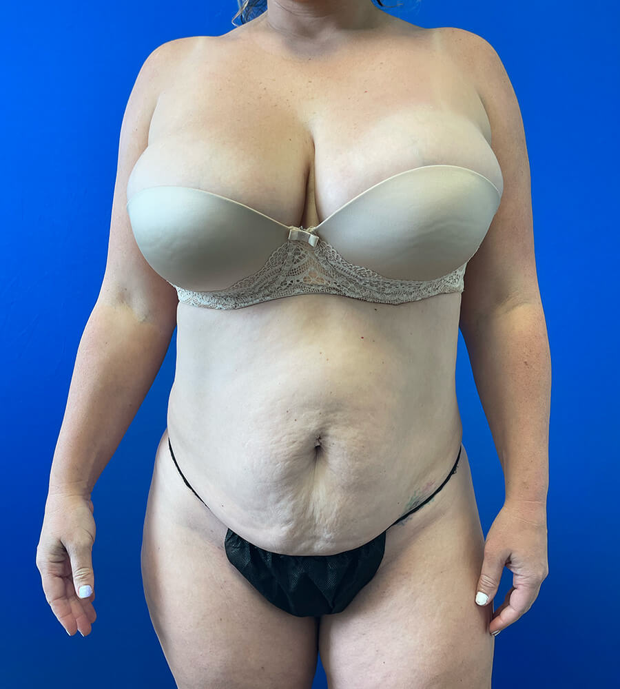 Cali-Tuck--x2122---Tummy-Tuck--Case--1510 | Before Cali-Tuck™ (Tummy Tuck)